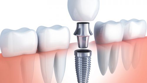 Cấy Ghép Implant